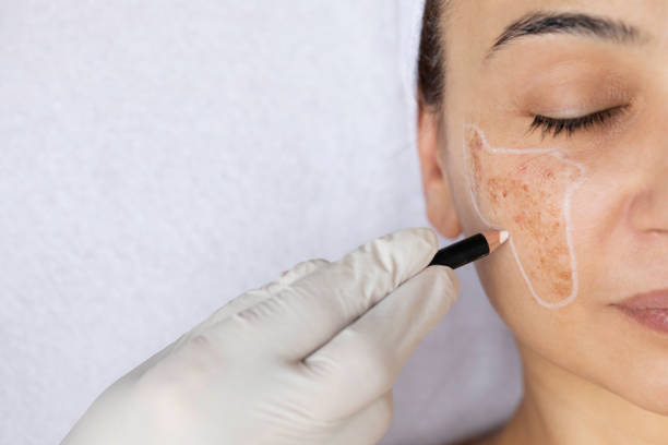 Skin Pigmentation Treatment Marking on Woman’s Face Close-up of a woman’s face suffering from hyperpigmentation (melasma) during a dermatology procedure, with a gloved hand outlining dark pigmentation spots using a pencil. The image represents skincare, medical treatment, skin brightening and dermatological care, highlighting precision and professional attention. face skin pigmentation stock pictures, royalty-free photos & images Skin Pigmentation Treatment Marking on Woman’s Face Close-up of a woman’s face suffering from hyperpigmentation (melasma) during a dermatology procedure, with a gloved hand outlining dark pigmentation spots using a pencil. The image represents skincare, medical treatment, skin brightening and dermatological care, highlighting precision and professional attention. face skin pigmentation stock pictures, royalty-free photos & images