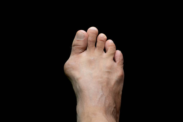 istock Foot with Hallux valgus, Bunion 2195824595