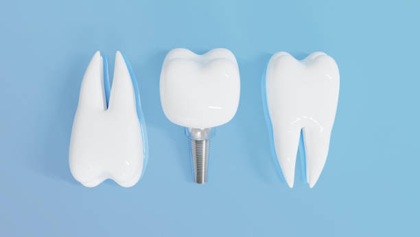 istock Dental Implants surgery concept, dentistry denture, Dental denture on blue background. 3D render. 2196011466