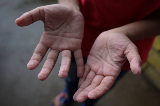 Wrinkled skin after bathing in water