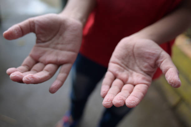 Wrinkled skin after bathing in water