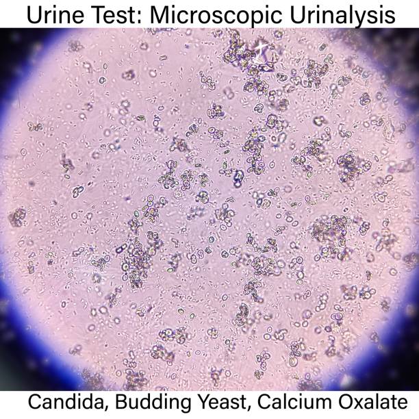 istock Urine Test Microscopic urinalysis, Candida Yeast, Budding Yeast, Calcium oxalate. 2197085540