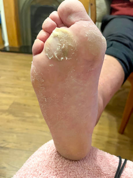 istock Senior man with burn on ball of foot 2197180647