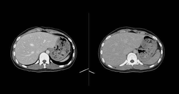 istock Contrast-enhanced CT whole abdomen study revealing normal anatomical structures, with no signs of pathology or abnormal fluid accumulation. 2197213370