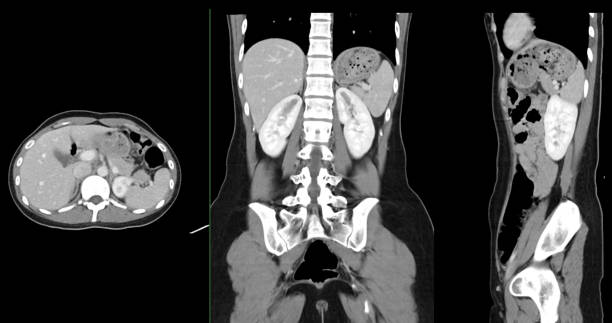 istock Contrast-enhanced CT whole abdomen study revealing normal anatomical structures, with no signs of pathology or abnormal fluid accumulation. 2197213446