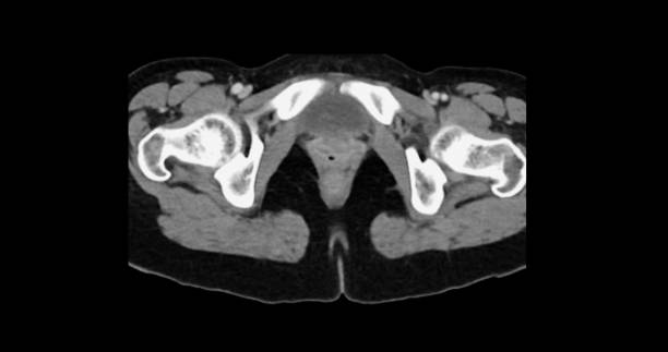 istock Contrast-enhanced CT whole abdomen study revealing normal anatomical structures, with no signs of pathology or abnormal fluid accumulation. 2197213633