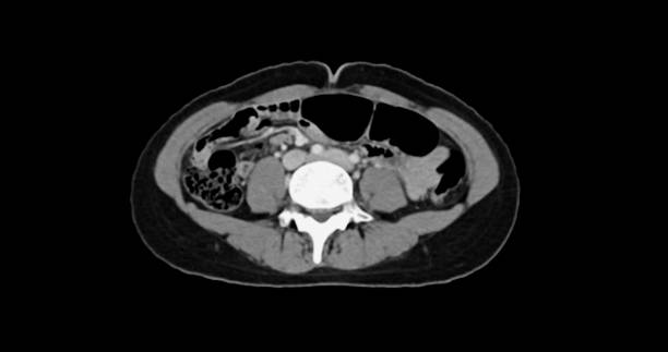 istock Contrast-enhanced CT whole abdomen study revealing normal anatomical structures, with no signs of pathology or abnormal fluid accumulation. 2197213777