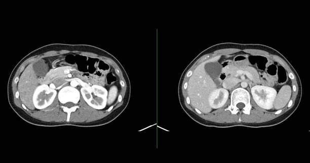 istock Contrast-enhanced CT whole abdomen study revealing normal anatomical structures, with no signs of pathology or abnormal fluid accumulation. 2197214387