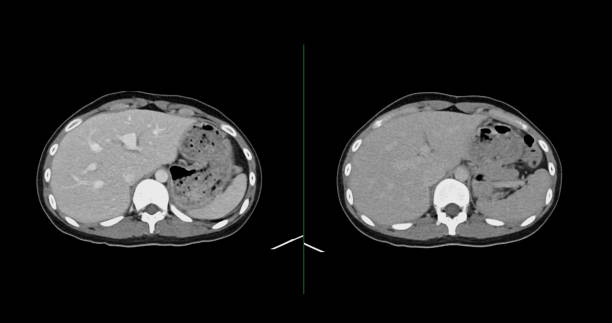istock Contrast-enhanced CT whole abdomen study revealing normal anatomical structures, with no signs of pathology or abnormal fluid accumulation. 2197214477