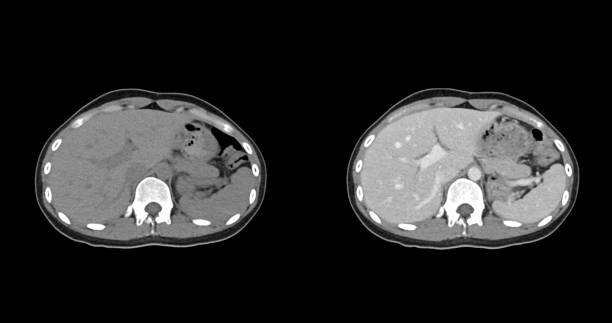 istock Contrast-enhanced CT whole abdomen study revealing normal anatomical structures, with no signs of pathology or abnormal fluid accumulation. 2197214492