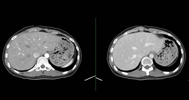 istock Contrast-enhanced CT whole abdomen study revealing normal anatomical structures, with no signs of pathology or abnormal fluid accumulation. 2197214536