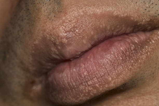 istock Close up of the Fordyce spot on lips 2197227216