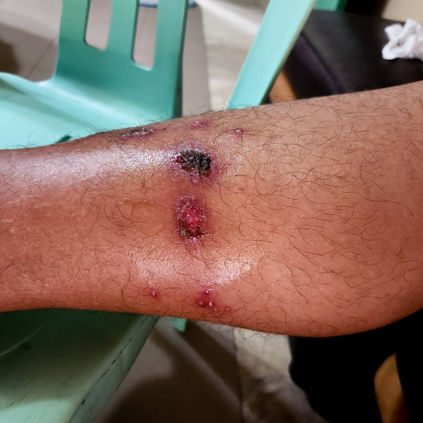 Abdominoplasty in the operating room