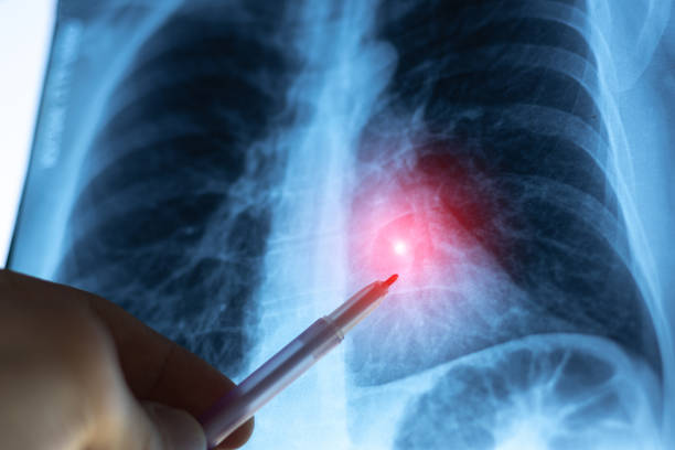 istock Doctor learning X-ray scan of a tuberculosis and lungs diseases. 2197437055