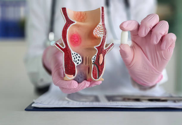 istock Proctologist doctor holds rectal suppository and artificial model of human rectum concept 2197448209