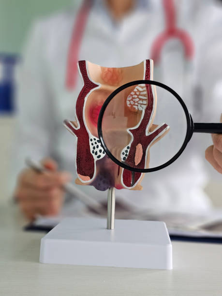 istock Proctologist with a magnifying glass in his hand showing rectum pathologies on an anatomical model 2197448214