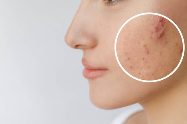 istock Young woman with acne 2197459741