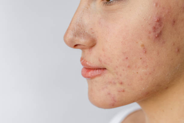istock Young woman with acne 2197460427