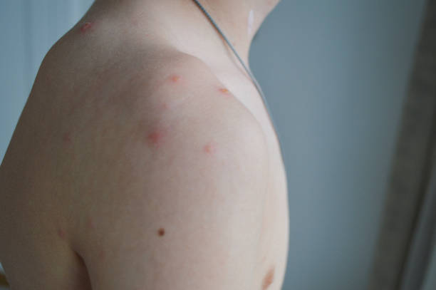 istock Child with Chickenpox Rash on Skin 2197493789