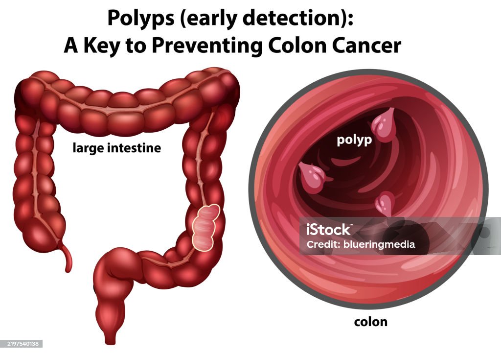 Polype Photo Illustration Of Colon Polyps And Large Intestine Stock Illustration ...