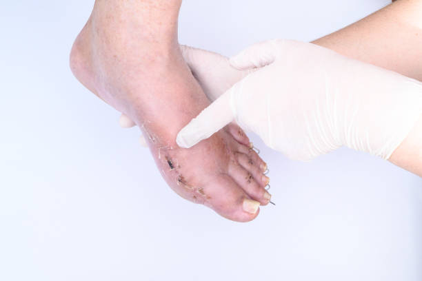 Close-up of badly cracked heel. Persons feet with dry skin. Barefoot adult with unattractive and unhealthy foot. Salon treatment and skin procedure needed concept