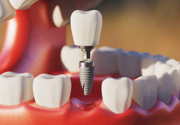istock Dental implant screw, placement procedure 2197893643