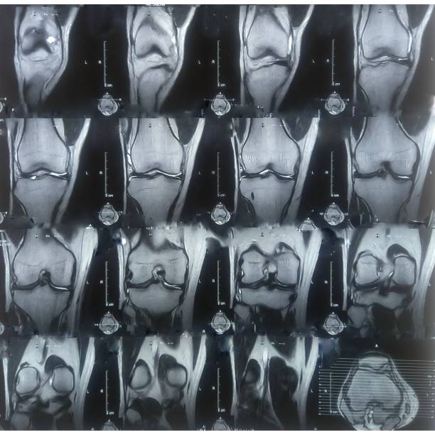 istock Knee joint MRI scan. Doctor pointed on area of knee joint, where pathology or problem is detected. Diagnosis of knee diseases by radiology. 2198185778