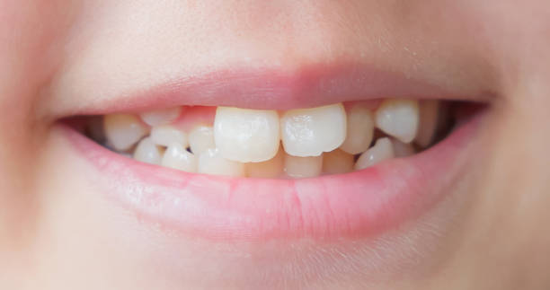 istock Child cavities and crooked teeth 2198279715