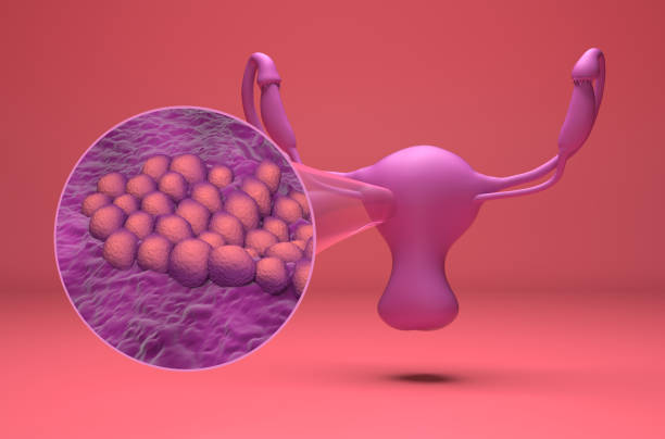 Endometrial cancer - isometric view 3d illustration stock photo
