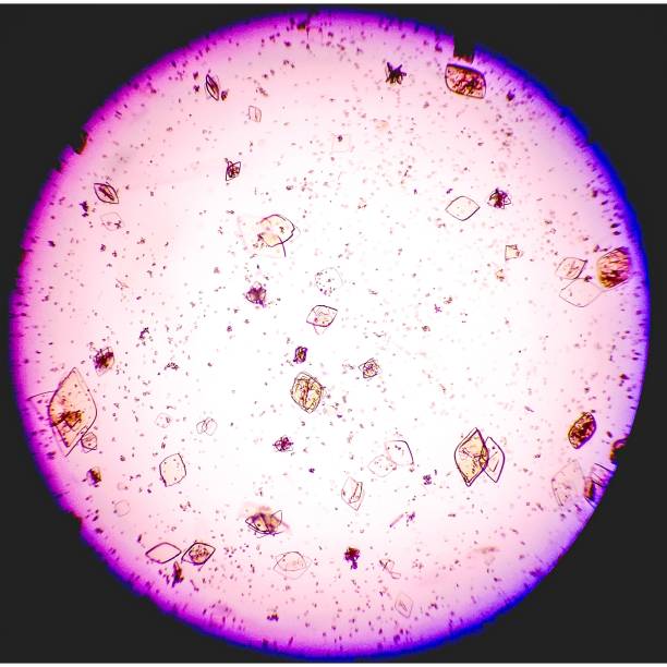 istock Microscopic urinalysis, Uric Acid, Calcium oxalate. 2198319940