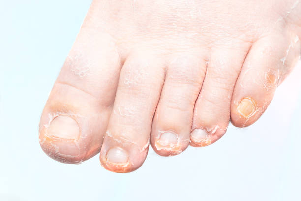 istock peeling skin on toes. Pedicure procedure 2198494055