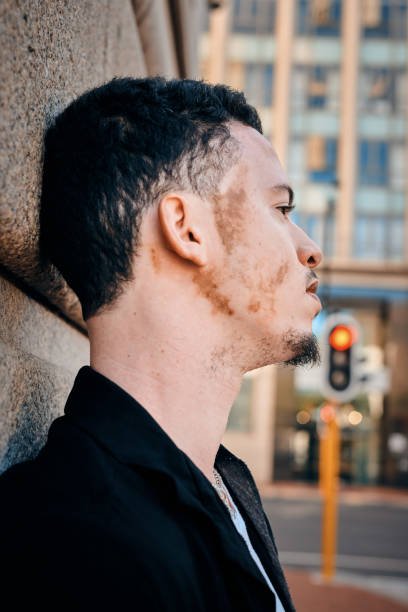 istock Stylish Man with Vitiligo Expressing Individuality in Urban Setting 2198650258