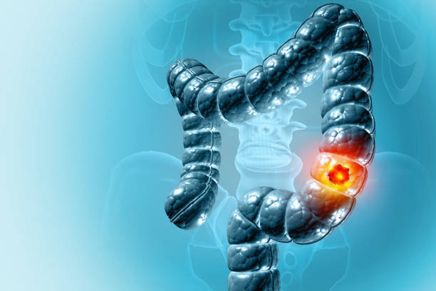 istock Colon cancer. Cancer attacking cell. Colon disease concept. 3d illustration 2199098239