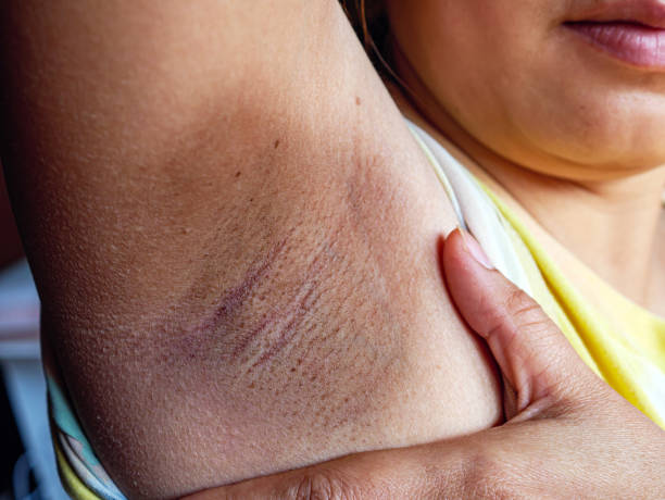 istock Close-up of Women armpit with problem black armpit. Dark and wrinkle armpit from deodorant allergic. 2199109743