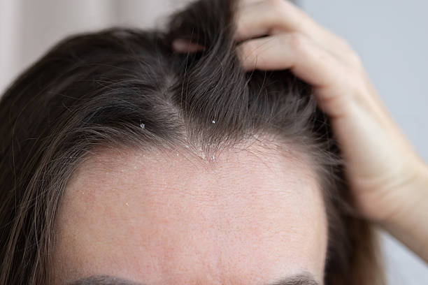 istock Closeup woman hair with dandruff. 2199137991