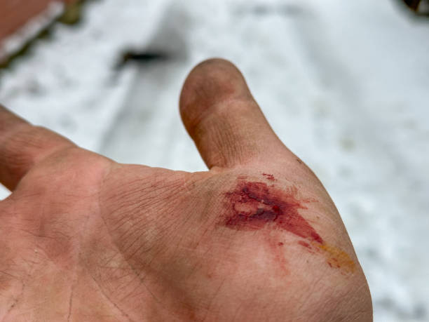 istock A hand shows a wound with blood, resting on a snowy surface, indicating a recent injury during outdoor activity in cold weather 2199191559
