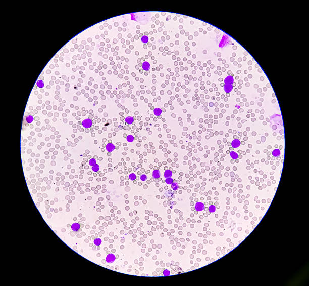 istock Acute leukemia, ALL (Acute lymphoblastic leukemia), peripheral blood smear, Under 100x light microscope to diagnosis of Acute leukemia. 2199394596