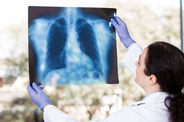 istock female doctor analyzing a chest x-ray of a patient 2199859996