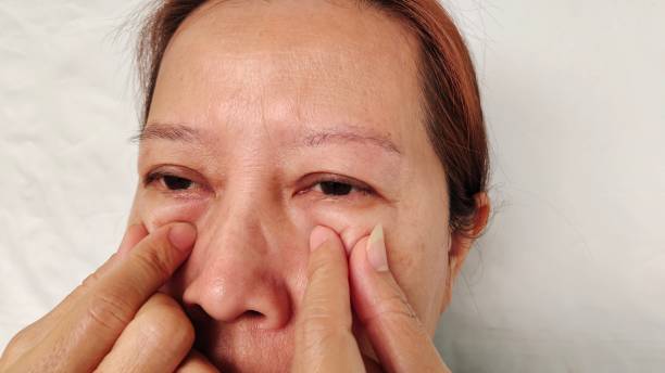 istock The ptosis and swelling, oedema and dark spots. 2200104961