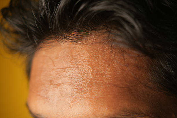 istock closeup of sweat on forehead against dark background , 2200144991