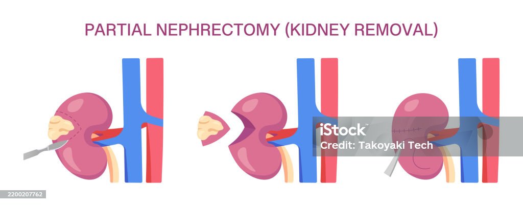 Nephrectomy Partial Nephrectomy Surgery Partial Nephrectomy Kidney Removal Cross ...