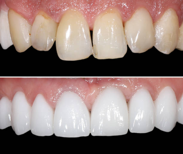 istock dental treatment by crowns and veneers 2200228180