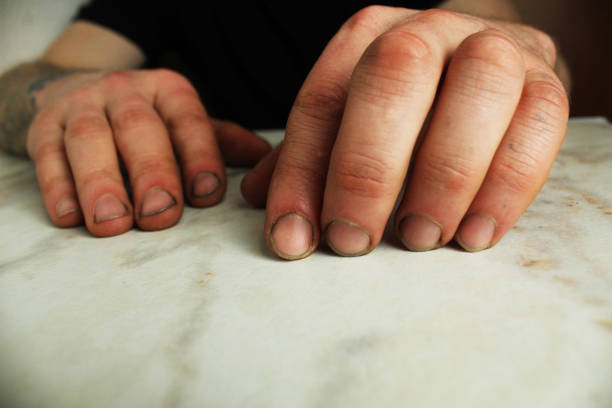 istock Male hands with broken nails close-up. Hand skin care 2200237833