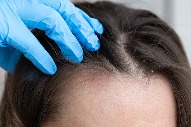 istock An appointment with a dermatologist. Woman has dermatitis on her scalp. 2200362162