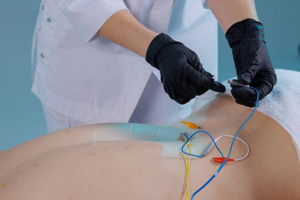 istock A physician connects an Electromyostimulator to needles on a man's back using the dry needling method. Traditional Chinese medicine acupuncture to relieve pain and improve well-being. 2200451630