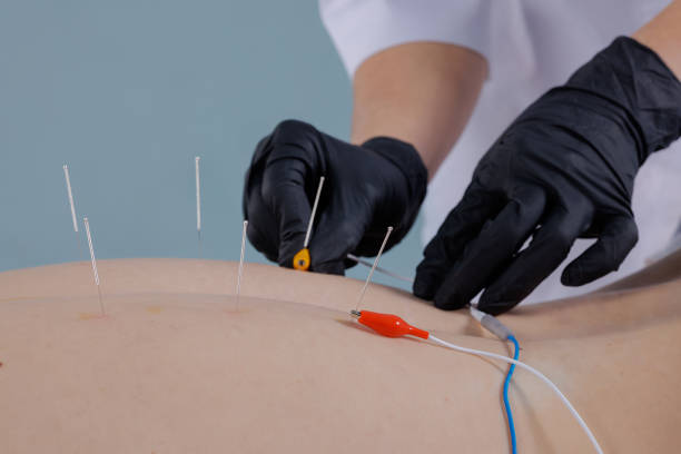 istock A physician connects an Electromyostimulator to needles on a man's back using the dry needling method. Traditional Chinese medicine acupuncture to relieve pain and improve well-being. 2200451631