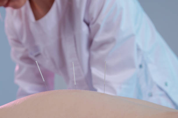 istock Close-up of a dry needling session where a practitioner inserts thin needles into a patient's back. Traditional Chinese medicine acupuncture to relieve pain and improve well-being. 2200451638