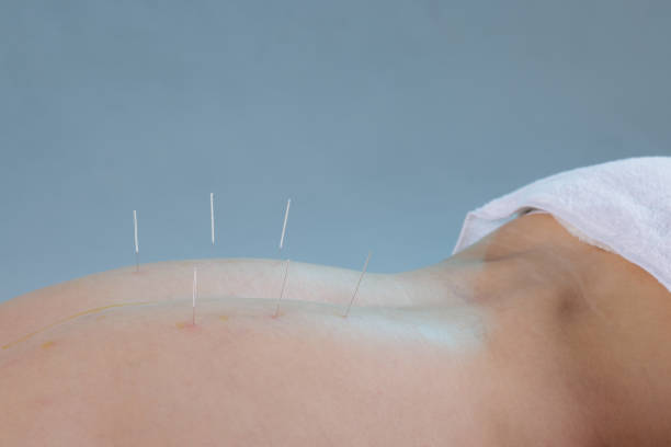 istock Close-up of a dry needling session where a practitioner inserts thin needles into a patient's back. Traditional Chinese medicine acupuncture to relieve pain and improve well-being. 2200451643