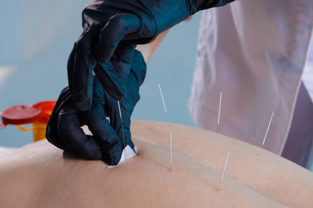 istock Close-up of a dry needling session where a practitioner inserts thin needles into a patient's back. Traditional Chinese medicine acupuncture to relieve pain and improve well-being. 2200451680