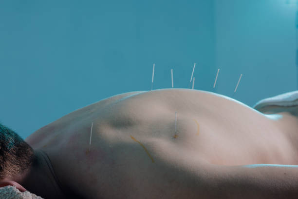 Close-up of a dry needling session where a practitioner inserts thin needles into a patient's back. Traditional Chinese medicine acupuncture to relieve pain and improve well-being.